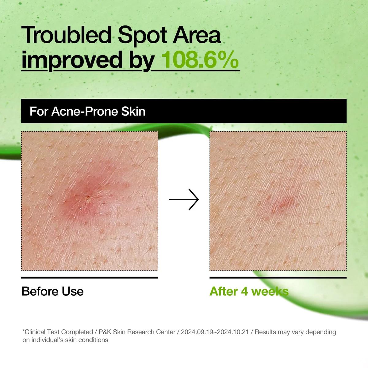 Azelaic Acid 10 Hyaluron Redness Soothing Serum 30ml